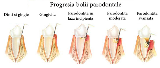 Boala parodontala Boala parodontala
