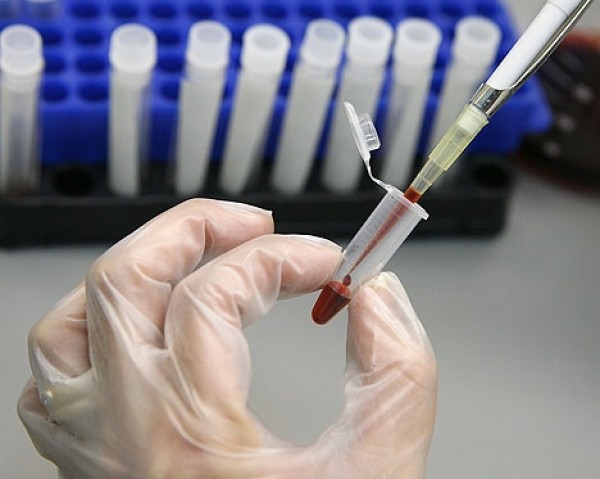 Cancerul oral si depistarea lui – protejeaza-te! Cancerul oral si depistarea lui – protejeaza-te!