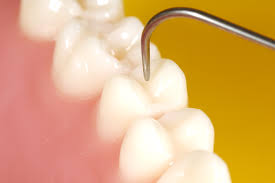 Ce cauzeaza aparitia cariei dentare? Ce cauzeaza aparitia cariei dentare?