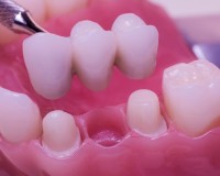 Implant sau punte dentara? Implant sau punte dentara?